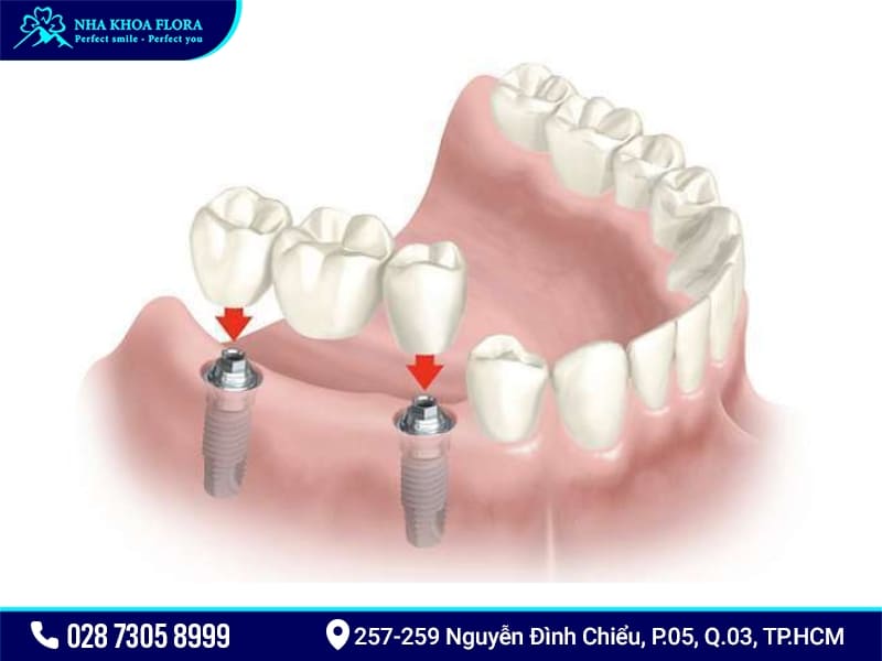 Cầu răng sứ trên Implant