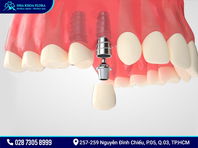 cấy ghép implant là gì