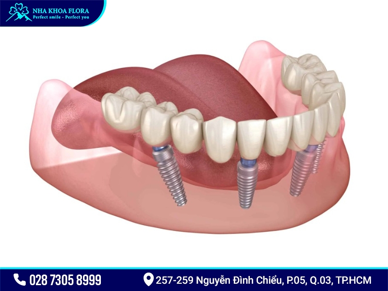 Cấy ghép Implant toàn hàm