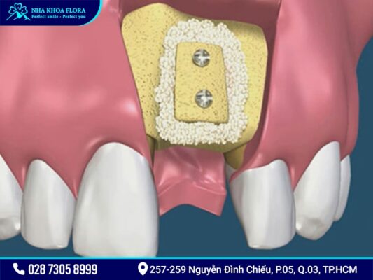 Cấy ghép xương để cắm Implant có mắc không? - ảnh 1
