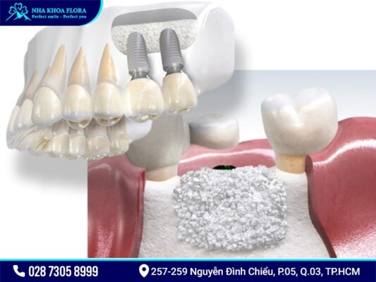 Cấy ghép xương để cắm Implant có mắc không? - ảnh 2