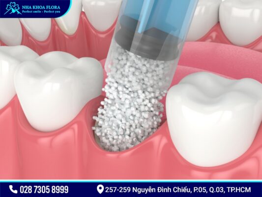 Cấy ghép xương để cắm Implant có mắc không? - ảnh 3