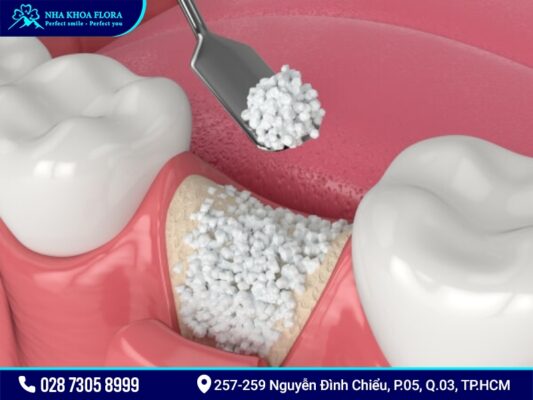 Cấy ghép xương để cắm Implant có mắc không? - ảnh 4