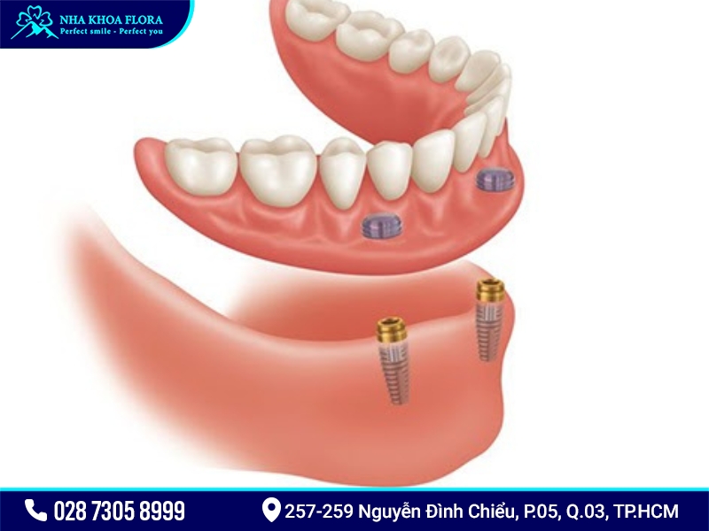 Hàm tháo lắp trên Implant 