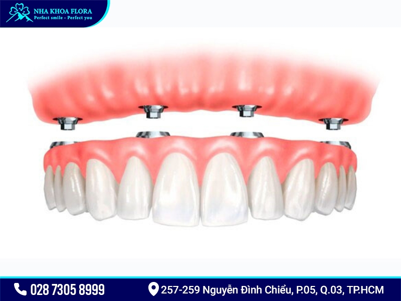 Hàm tháo lắp trên Implant