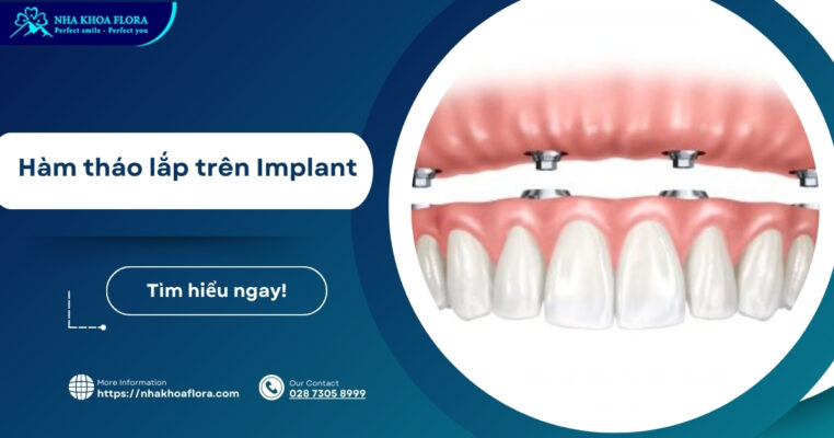 Hàm tháo lắp trên Implant