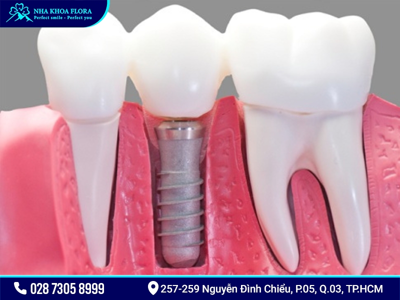 Trồng răng Implant đơn lẻ