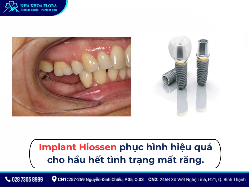 implant hiossen