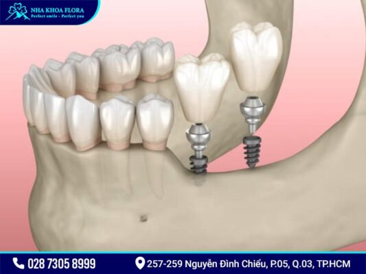 Mini Implant giá bao nhiêu? - ảnh 1