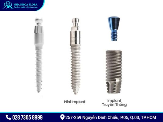 Mini Implant giá bao nhiêu? - ảnh 2