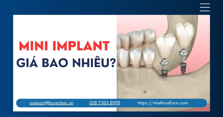 Mini Implant giá bao nhiêu?
