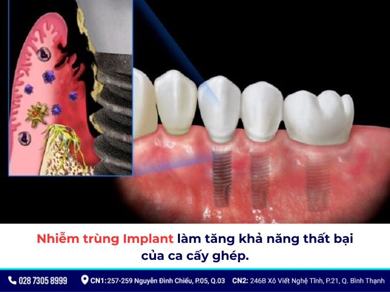 nhiễm trùng implant