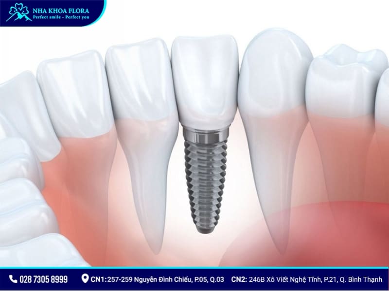 ưu điểm của trồng răng implant