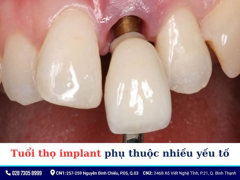Nguy cơ thất bại khi trồng implant
