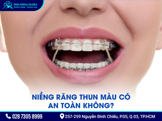 Niềng răng thun màu - ảnh 3