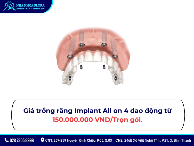trồng răng implant all on 4