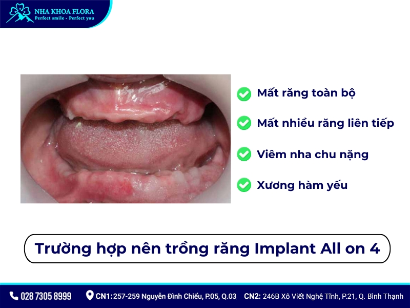 trồng răng implant all on 4