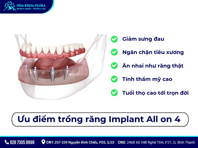 trồng răng implant all on 4