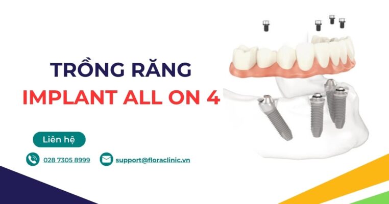 trồng răng implant all on 4