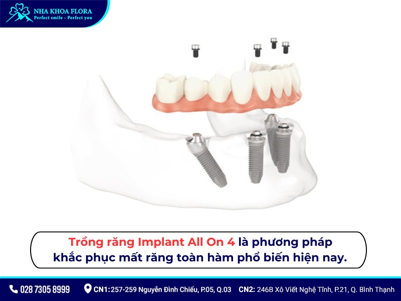 trồng răng implant all on 4