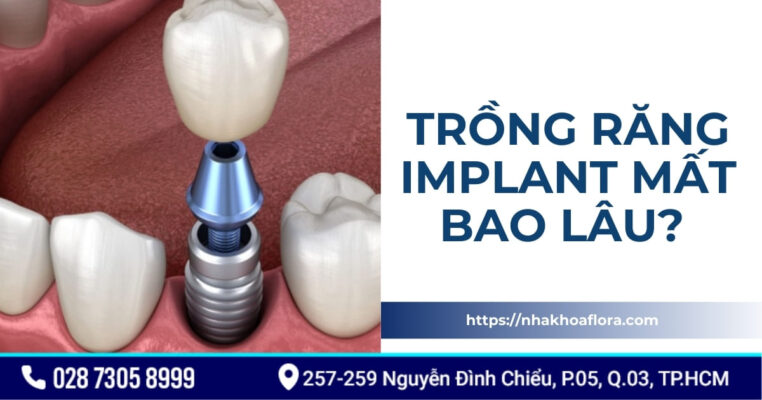 Trồng răng implant mất bao lâu