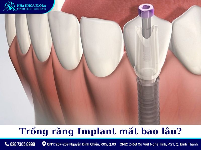 thời gian trồng răng implant