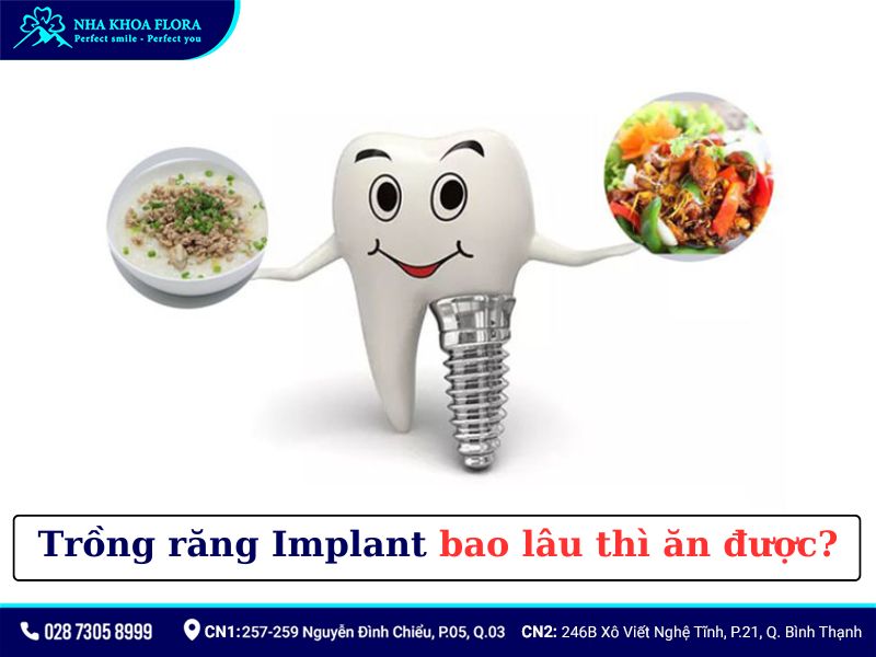 Trồng răng implant bao lâu thì ăn được