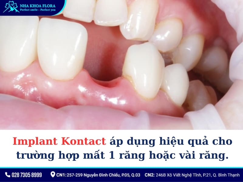 trụ implant kontact