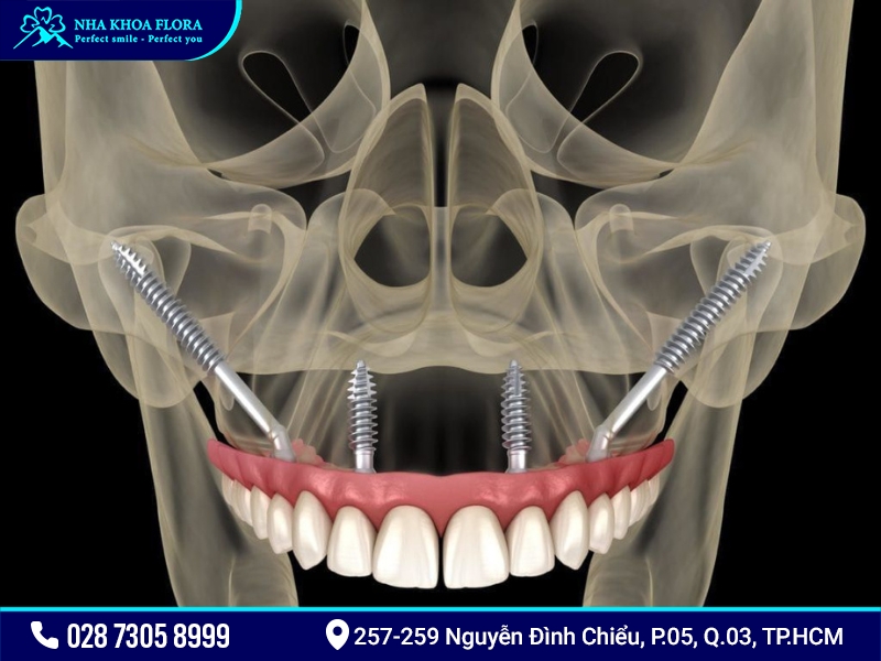 Zygoma Implants