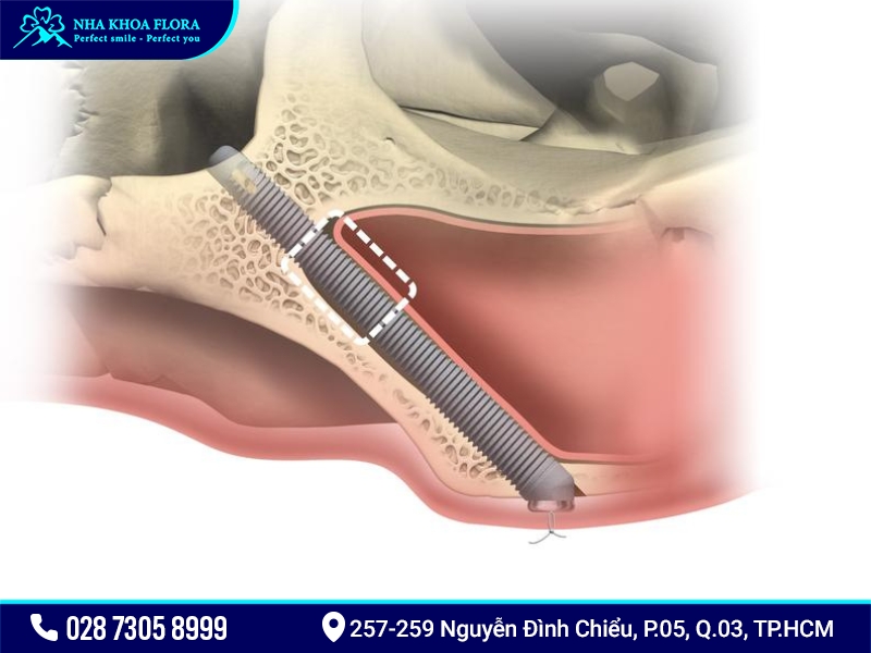 Ưu điểm cấy ghép Implant xương gò má