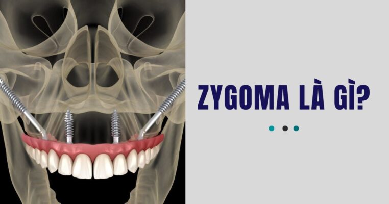 zygoma Implant