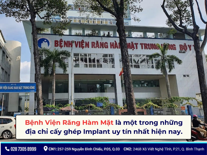 bảng giá trồng răng implant bệnh viện răng hàm mặt