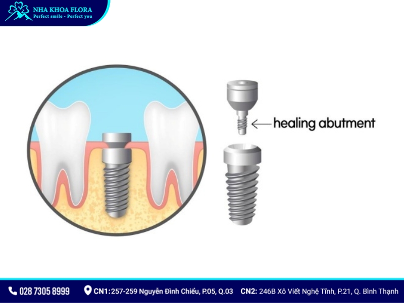 healing abutment