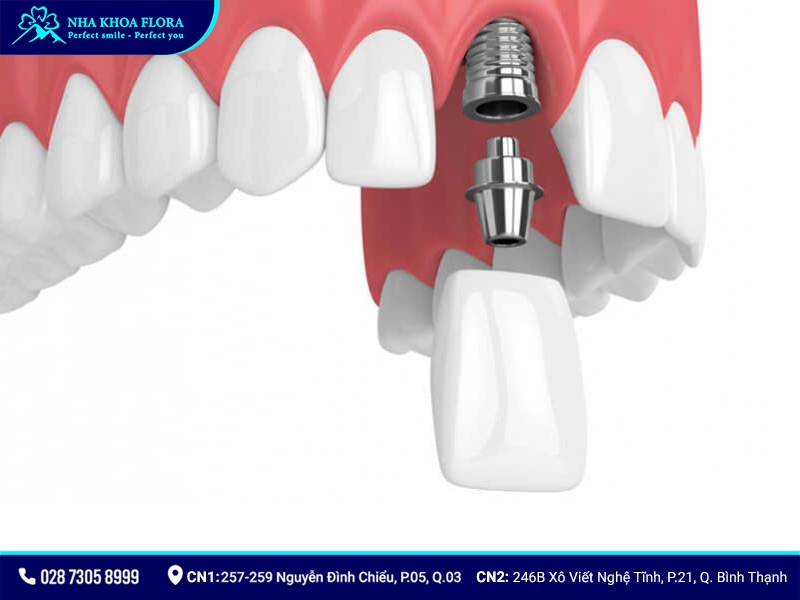 cắm implant răng cửa