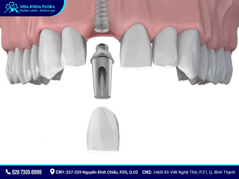 Trồng Implant răng cửa 