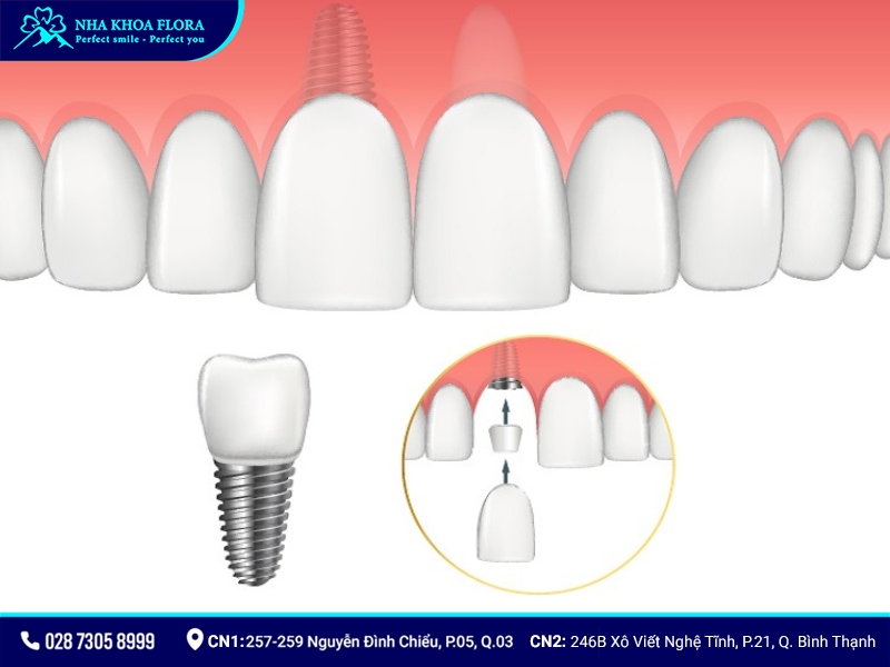 độ bền của implant răng cửa