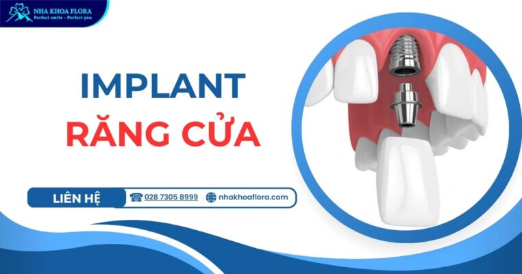 implant răng cửa