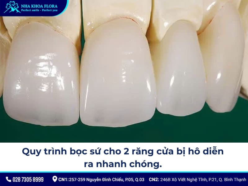 bọc răng sứ 2 răng cửa bị hô