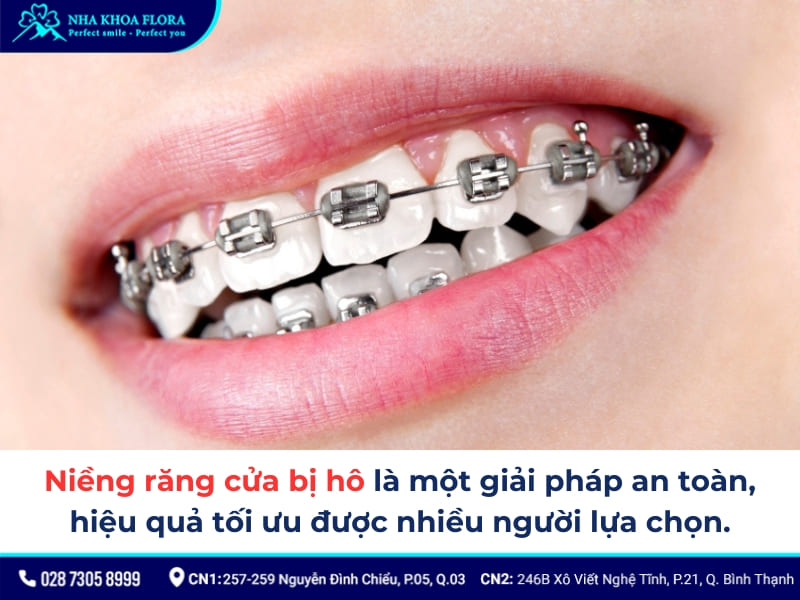 bọc răng sứ 2 răng cửa bị hô