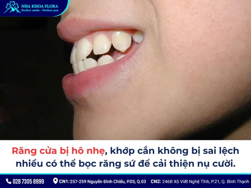 bọc răng sứ 2 răng cửa bị hô