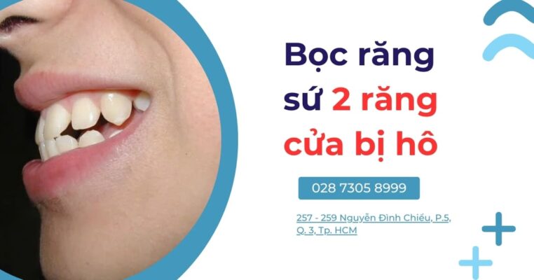 bọc răng sứ 2 răng cửa bị hô