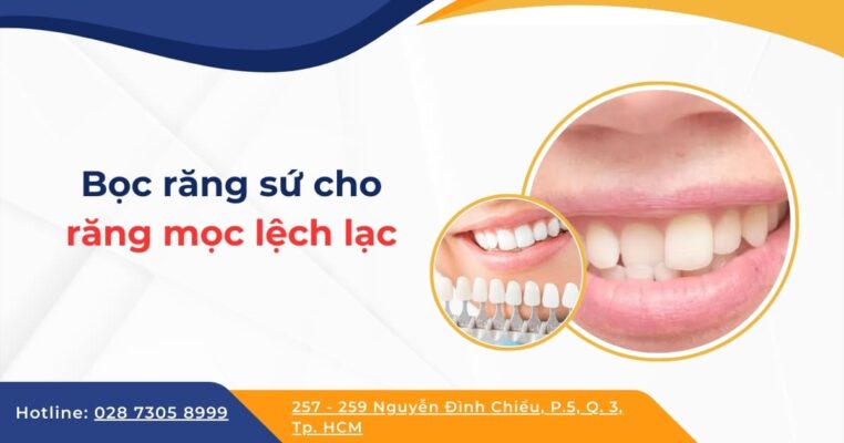 bọc răng sứ cho răng lệch lạc