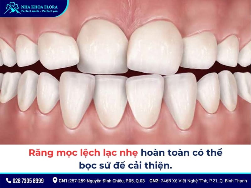 bọc răng sứ cho răng lệch lạc