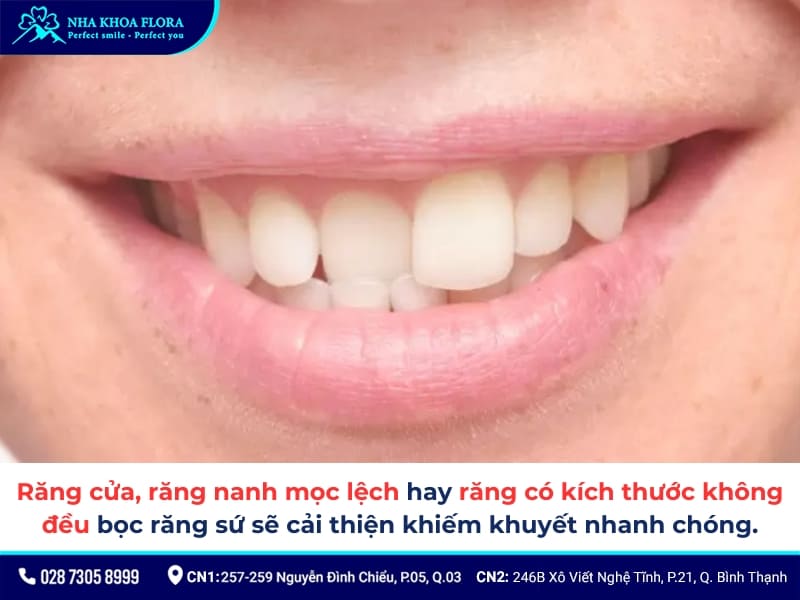 bọc răng sứ cho răng lệch lạc