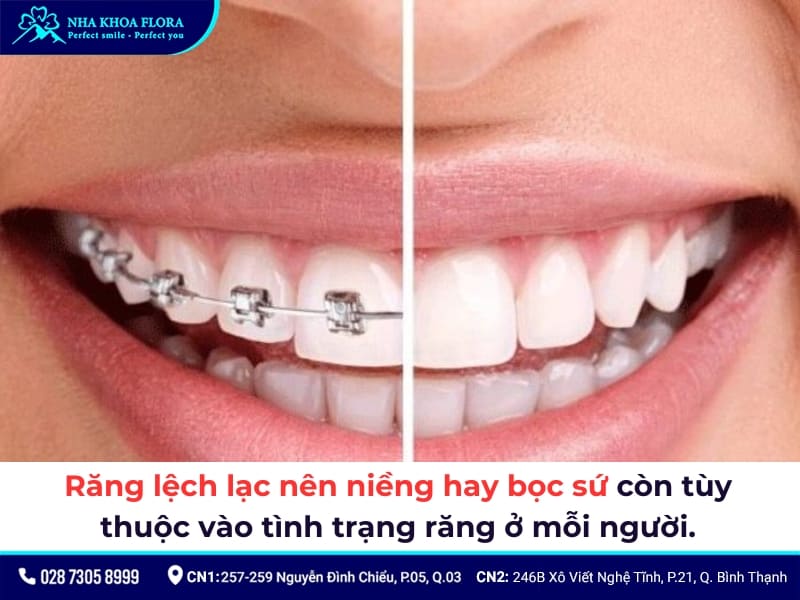 bọc răng sứ cho răng lệch lạc