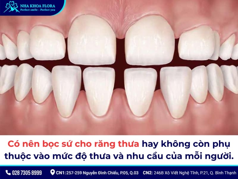 bọc răng sứ cho răng thưa