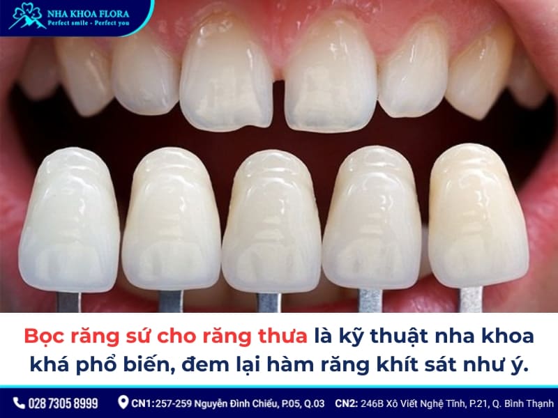 bọc răng sứ cho răng thưa
