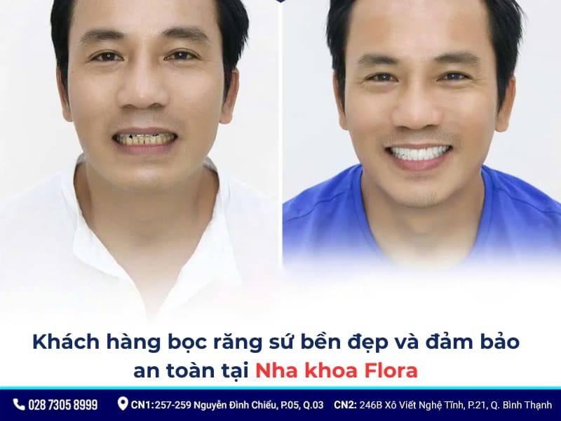 bọc răng sứ lần 2