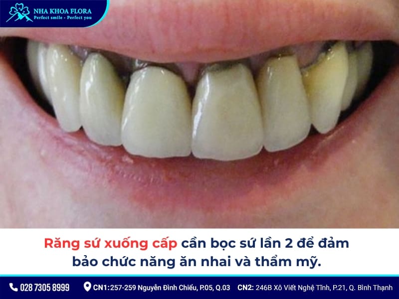 bọc răng sứ lần 2