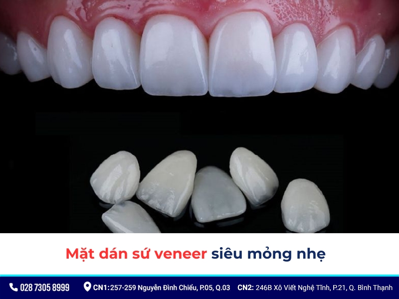 bọc răng sứ nguyên hàm